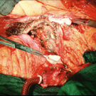 lebertransplantation.jpg