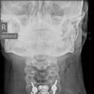 Röntgenbilder zeigen Bruch