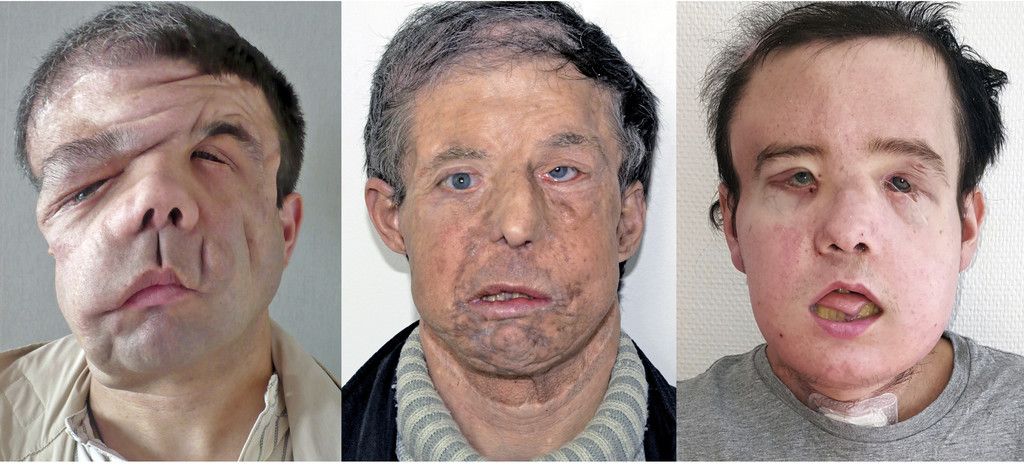 Double_Face_Transplant_71766.jpg