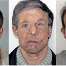 Double_Face_Transplant_71766.jpg