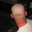 Die schlimmsten Sonnenbrände