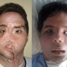 Gesichtstransplantation in Madrid 