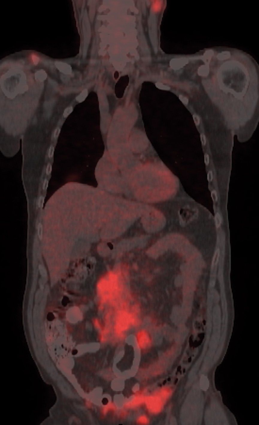 PET-CT-Fusion_Coronal_patient_with_multiple_myeloma.jpg