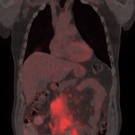 PET-CT-Fusion_Coronal_patient_with_multiple_myeloma.jpg