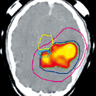 PET-CT-Hirntumor.jpg