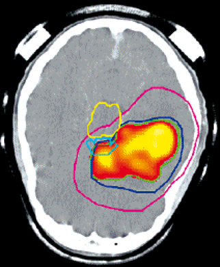 PET-CT-Hirntumor.jpg