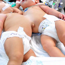 Barcelona: Siamesische Zwillinge erfolgreich getrennt