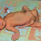 Pakistan: Baby mit sechs Beinen operiert