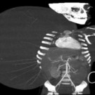 Zweijährigem in Mexiko 15 Kilo-Tumor entfernt